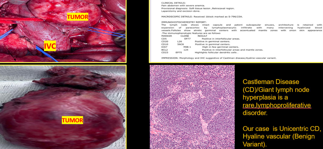 RETROPERITONEAL RETRO CAVAL TUMOR